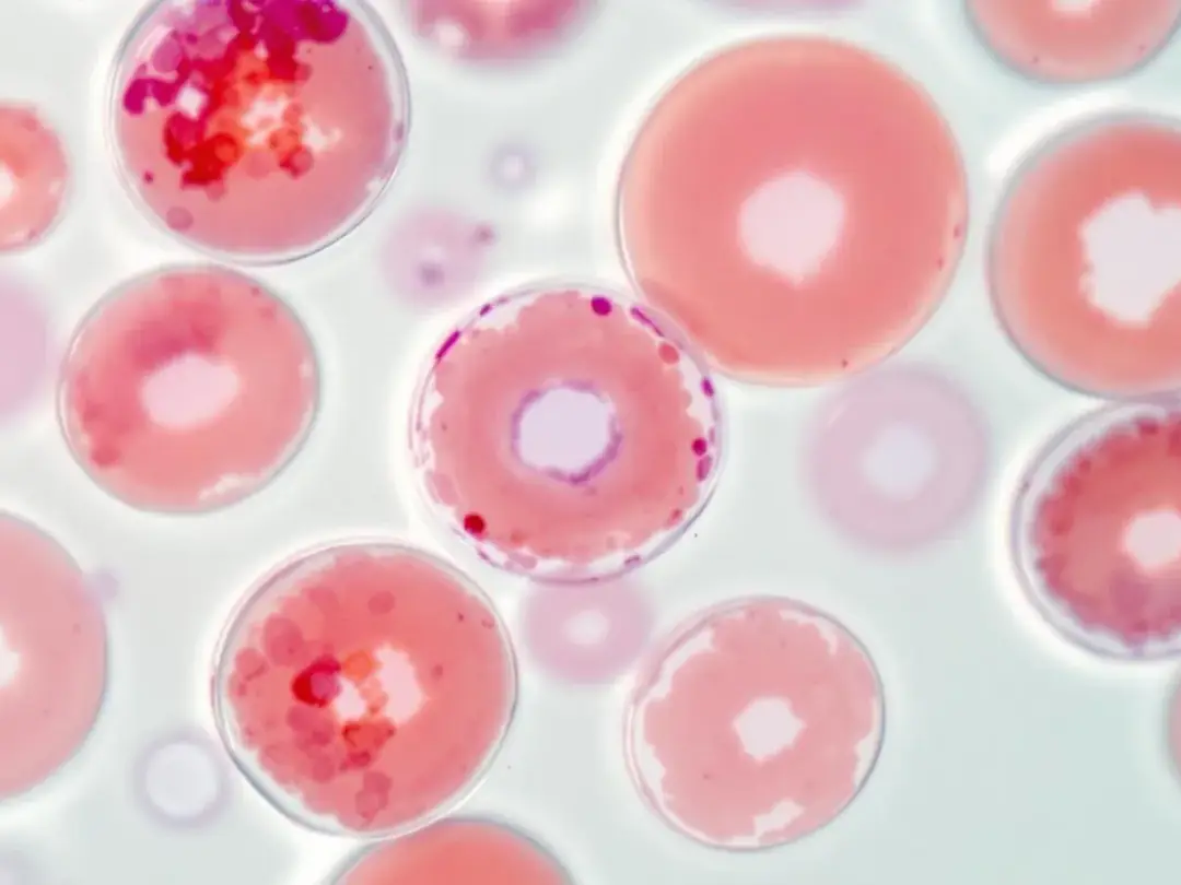 A microscopic view showcases healthy red blood cells alongside damaged cells indicative of hemolytic anemia...