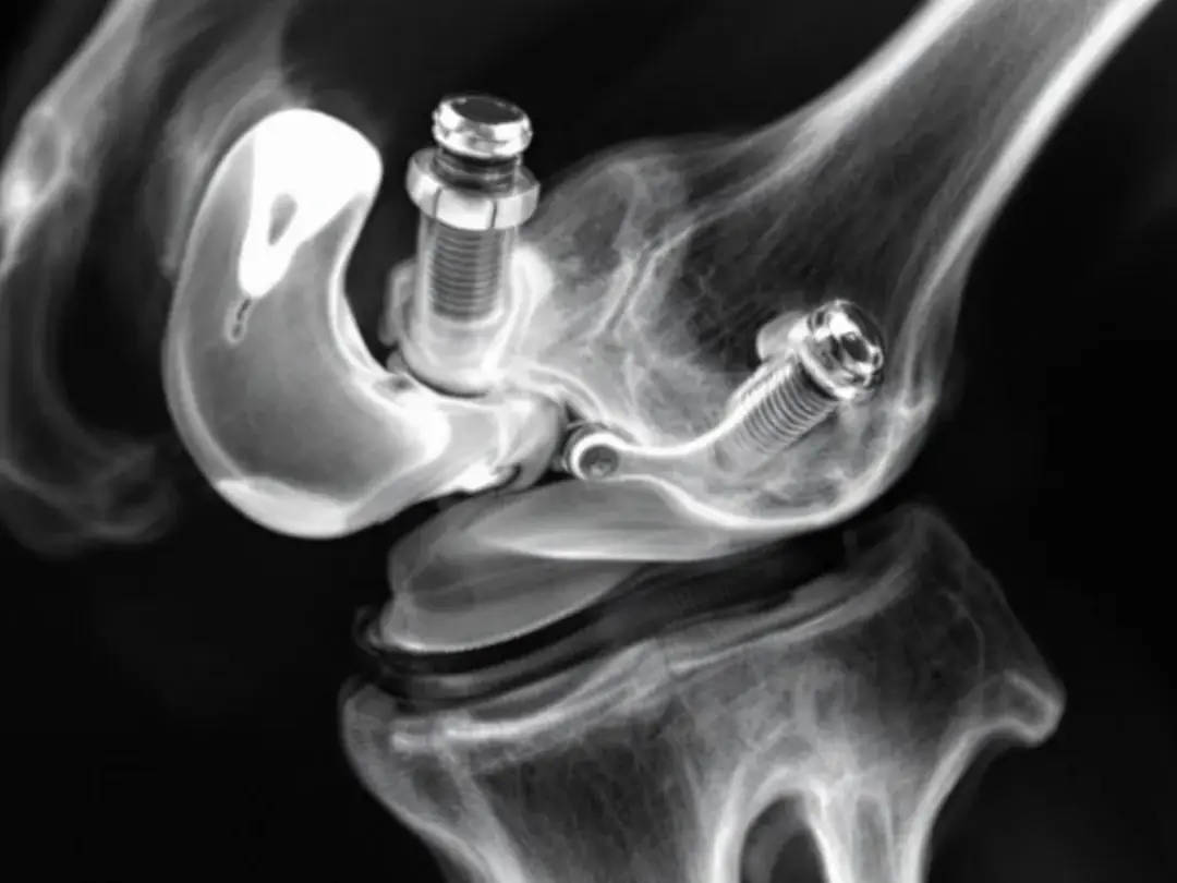 An X-ray image displays a successful surgical correction of patellar luxation, highlighting the hardware placement in...